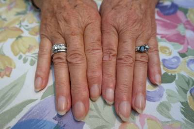 Состояние ногтей может говорить о заражении COVID-19