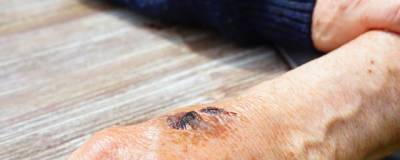 Случаи заражения кожной сибирской язвой выявлены в Китае