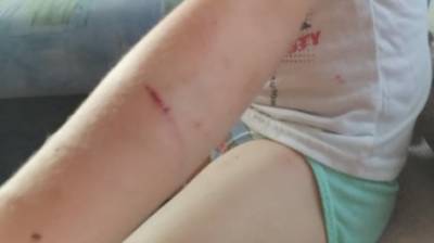 В Бессоновке ребенок пострадал от нападения собаки