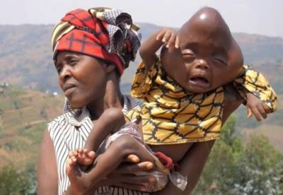 В Руанде женщина родила ребенка с головой в форме груши (фото)