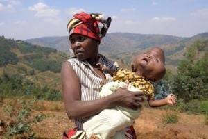 В Руанде женщина родила ребенка с головой в форме груши. ФОТО