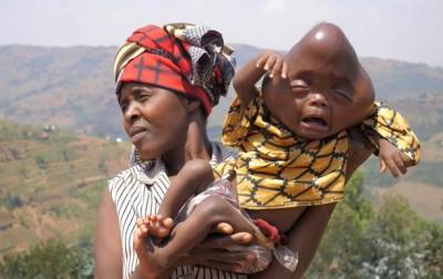 В Руанде женщина родила мальчика с головой в форме груши | Новости и события Украины и мира, о политике, здоровье, спорте и интересных людях