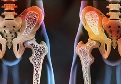 Причины возникновения остеопороза