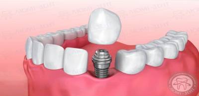 Импланты зубов в Люмидент – восстановите улыбку с профессионалами