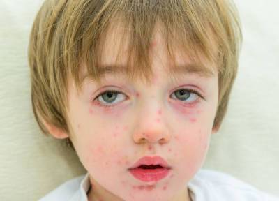 Шесть детских инфекций с похожей сыпью: как не пропустить самую серьезную