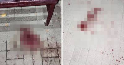 В Бийске незнакомец напал на девушку и раздробил ей камнем лицо