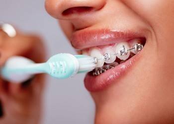 Гигиена полости рта при ношении брекетов: советы ортодонта