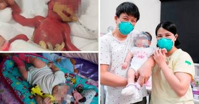 В Сингапуре из больницы выписали девочку, родившуюся весом в 212 грамм