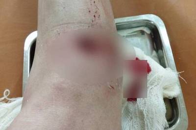 «Позавтракала моей ногой»: собака напала на женщину в Улан-Удэ