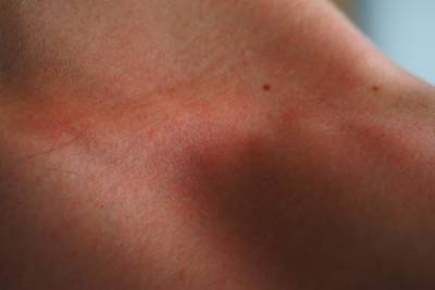 Дерматолог опровергла миф о связи заболеваний кожи с питанием