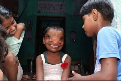 В Индии девочку с двумя носами признали воплощением божества