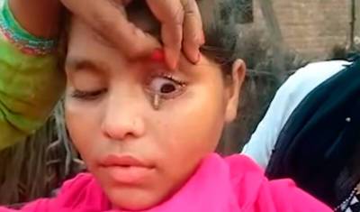 Врачи в недоумении: индийская девочка плачет каменными слезами