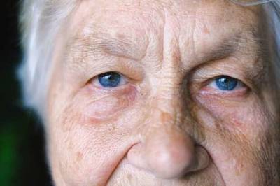 Побочные эффекты статинов: неблагоприятное действие на глаза — диплопия