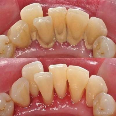 ​Как избавиться от зубного камня