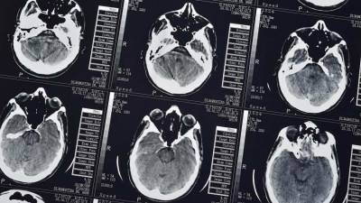 Ученые придумали эффективный метод выявления болезни Альцгеймера