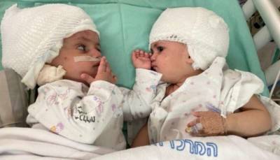 Израильтяне провели уникальную операцию по разделению сиамских близнецов