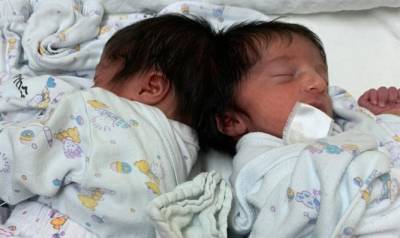 Впервые в Израиле разделили близнецов со сросшимися головами