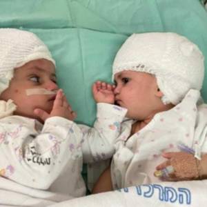 В Израиле врачи успешно разделили сиамских близнецов. Видео