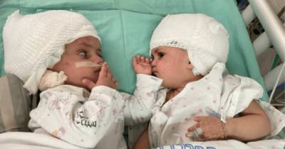 "Они смотрели друг на друга": в Израиле хирурги разделили сиамских близнецов