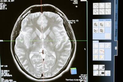 Ученые раскрыли влияние COVID-19 на мозг