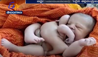 Женщина в Индии родила ребенка с восемью конечностями