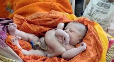 В Индии на свет появился необычный ребенок: у младенца 4 руки и 4 ноги