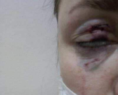 В ХМАО бродячая собака напала на женщину и чуть не лишила ее глаза