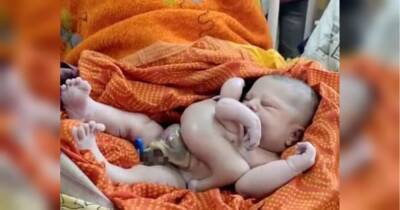 Вважають втіленням бога Вішну: в Індії народилася дитина з чотирма руками та ногами