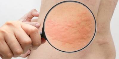 Коронавирус может провоцировать заболевания кожи — дерматолог