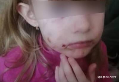 На 4-летнюю девочку напала стая бездомных собак в Шахтерске