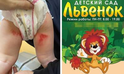 Для полуторагодовалого малыша день в частном детском саду в Петрозаводске закончился медико-судебной экспертизой