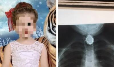 В Башкирии врачи спасли девочку, которая проглотила цепочку с подвеской