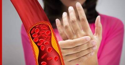 Симптомы высокого холестерина: 7 необычных проявлений заболевания в руках