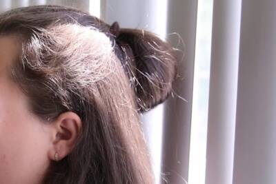 Инфекционист Ищенко назвала возможные причины выпадения волос