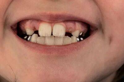 Дитячі коронки на зуби: коли встановлювати та переваги