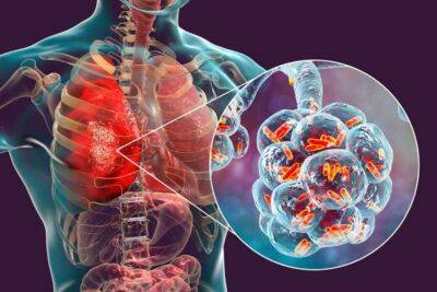 У ВООЗ заявили про зростання захворюваності на туберкульоз вперше за багато років