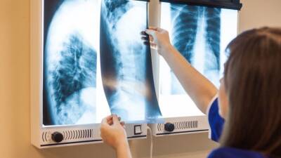 Еще двое пациентов могут быть жертвами «смертельного рентгена» в Петербурге