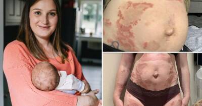 Тело в волдырях: в Британии у женщины началась аллергия на собственного ребенка (фото)
