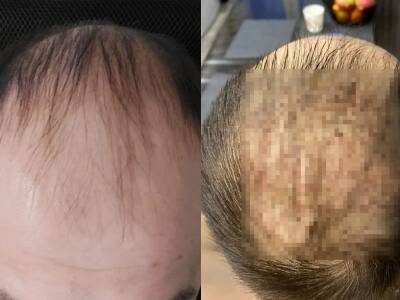 Жители Новосибирска получили кровавые залысины после операции по пересадке волос за 200 тысяч