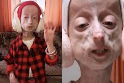 В Новосибирске 12-летняя девочка с редким генетическим дефектом стала звездой TikTok
