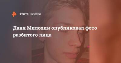 Даня Милохин опубликовал фото разбитого лица