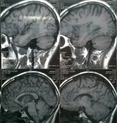Сканирование мозга помогло обнаружить причину снижения когнитивных функций при болезни Альцгеймера
