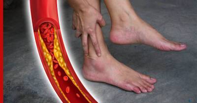 Симптомы высокого холестерина: необычные признаки в ногах