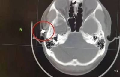 Мужчина, страдавший от головных болей, 20 лет прожил с пулей в голове