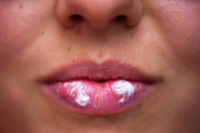Дерматолог рассказала о пользе зубной пасты при герпесе на губах
