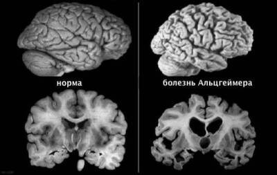 У перенёсших COVID-19 нашли изменения в мозге по типу болезни Альцгеймера