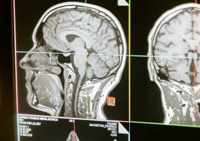 Ученые выявили у умерших от COVID-19 изменения в мозге как при болезни Альцгеймера