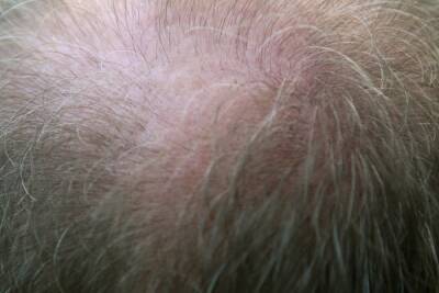 Волосы для пересадки лысеющим людям начали выращивать на мышах
