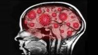 Дефекты мозга как у больных Альцгеймера: ученые обнаружили аномалию у переболевших COVID-19