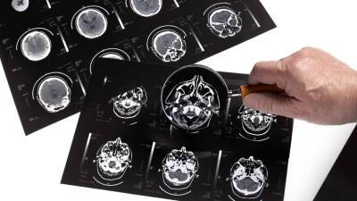 Невролог Мхитарян рассказала о возможном негативном влиянии коронавируса на работу мозга